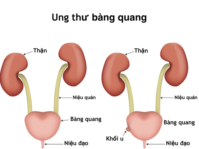 Các phương pháp điều trị ung thư bàng quang